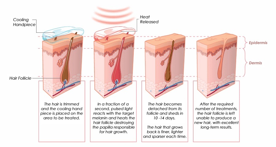 Hair Removal Helsinki - IPL STUDIO