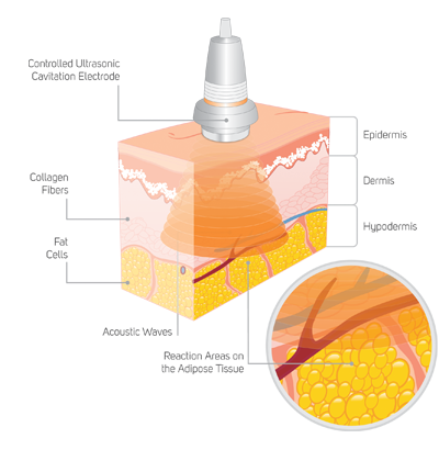 Ultrasonic Cavitation, Frequently Asked Question