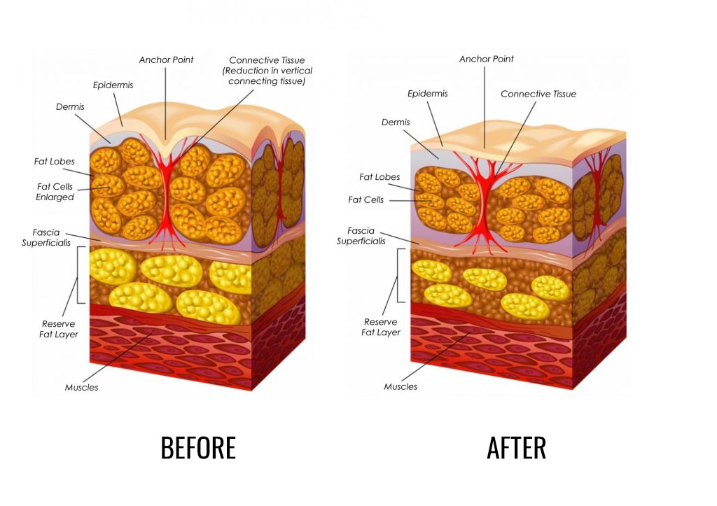 Vacuum Radiofrequency Slimming Treatment Helsinki - IPL STUDIO